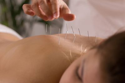 Ponderosa-acupuncture